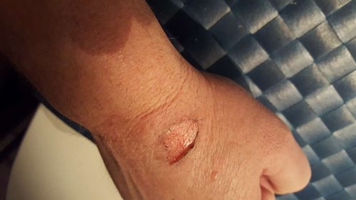 14.01 morgen, før hospital.jpg (38.06 KiB) Vist 5873 gange Sådan så det ud, da jeg spiste morgenmad. Da jeg opdagede de røde streger måtte jeg ringe 1813.